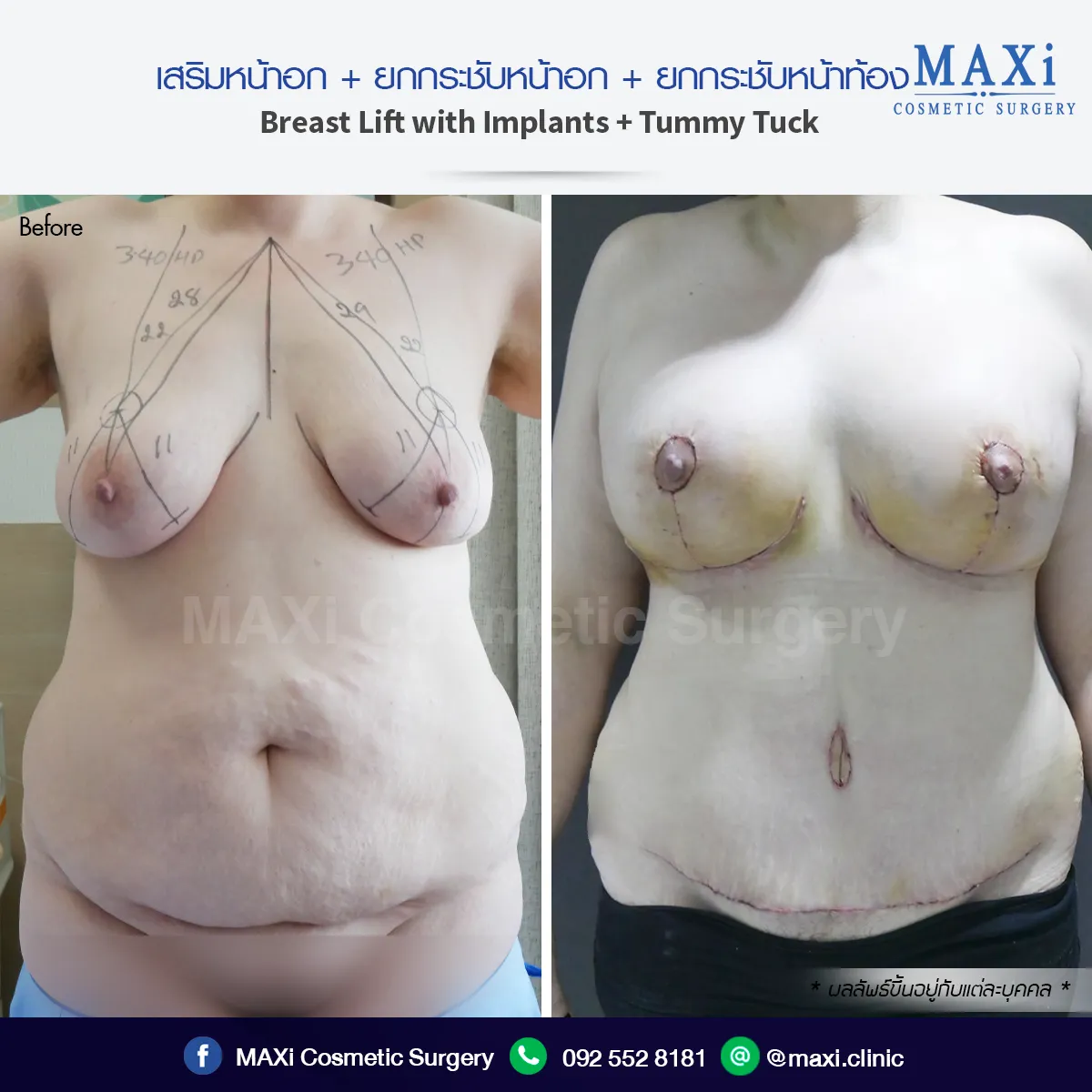 ผลลัพธ์เสริมหน้าอกก่อนและหลัง ทำให้รูปร่างได้สัดส่วนมั่นใจมากขึ้น