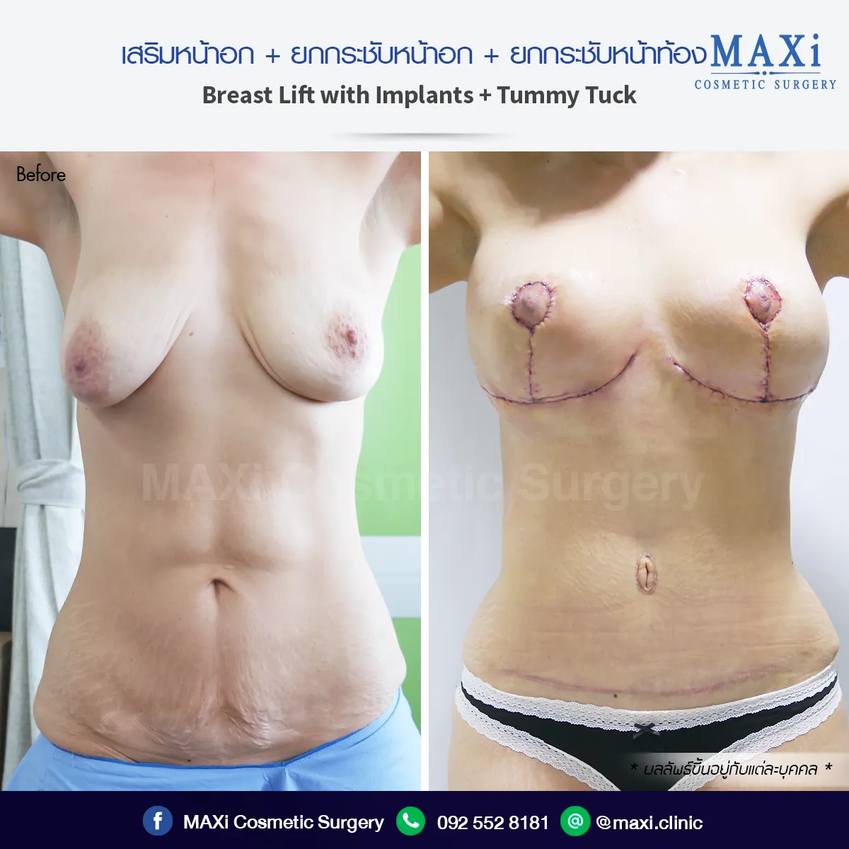 ก่อนและหลังเสริมหน้าอกที่คลินิก เสริมให้ทรงหน้าอกสวยเป็นธรรมชาติ ไม่เป็นบล็อก
