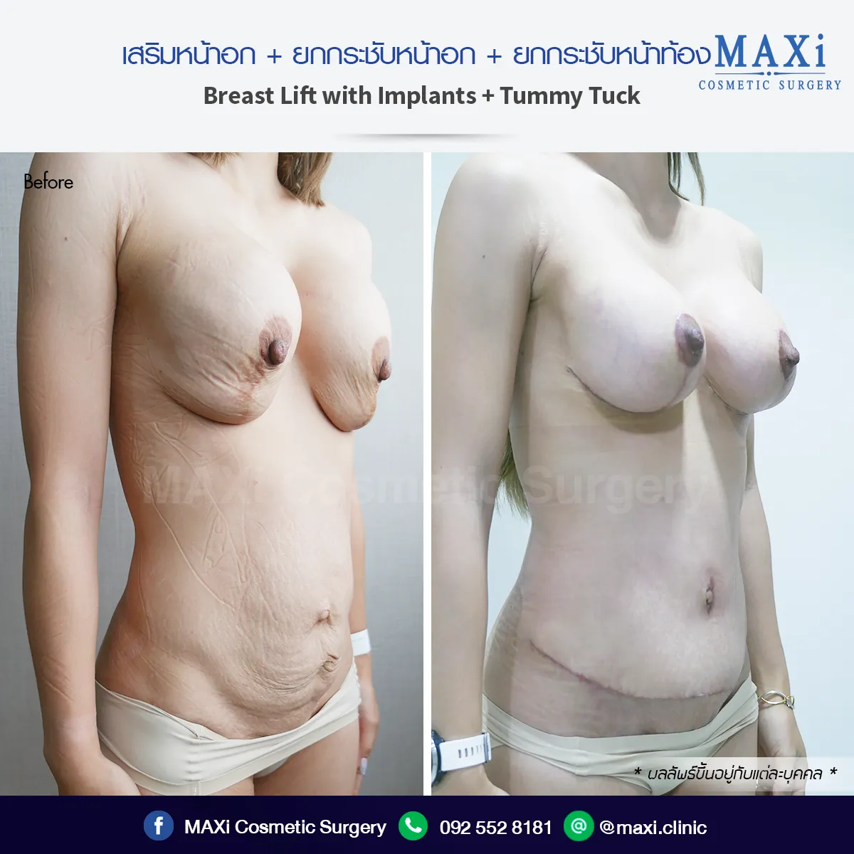 ภาพเปรียบเทียบก่อนและหลังยกกระชับหน้าอก เต้ายกสูงขึ้น สัดส่วนได้รูปสวยงาม