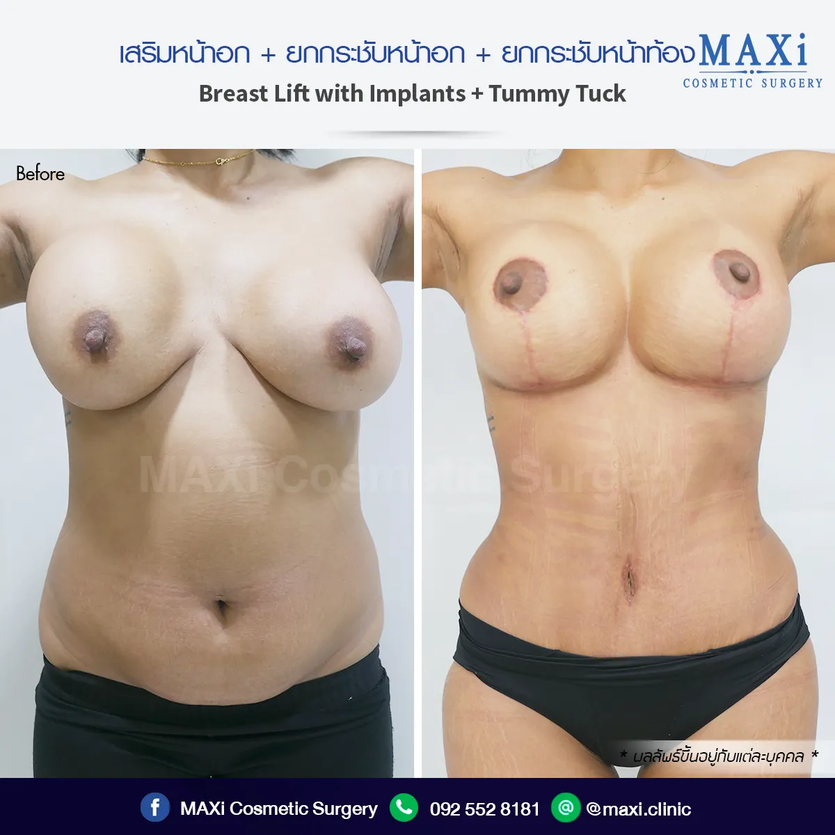 ผลลัพธ์ก่อนและหลังทำหน้าอก เสริมทรงให้สวยอวบอิ่ม เข้ากับสรีระอย่างพอดี