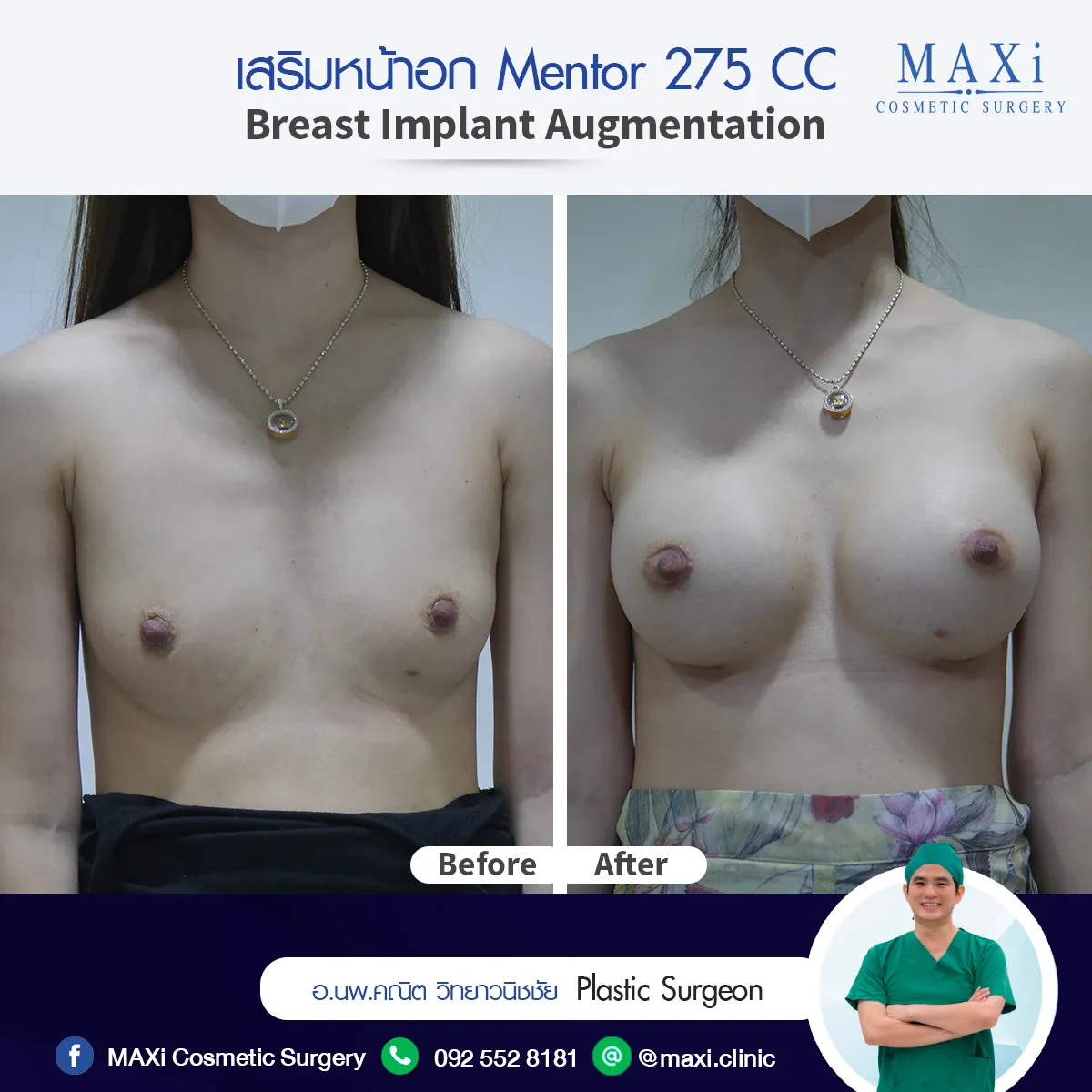 ภาพรีวิวเสริมนม ก่อนและหลังศัลยกรรมเสริมหน้าอกทรงธรรมชาติ