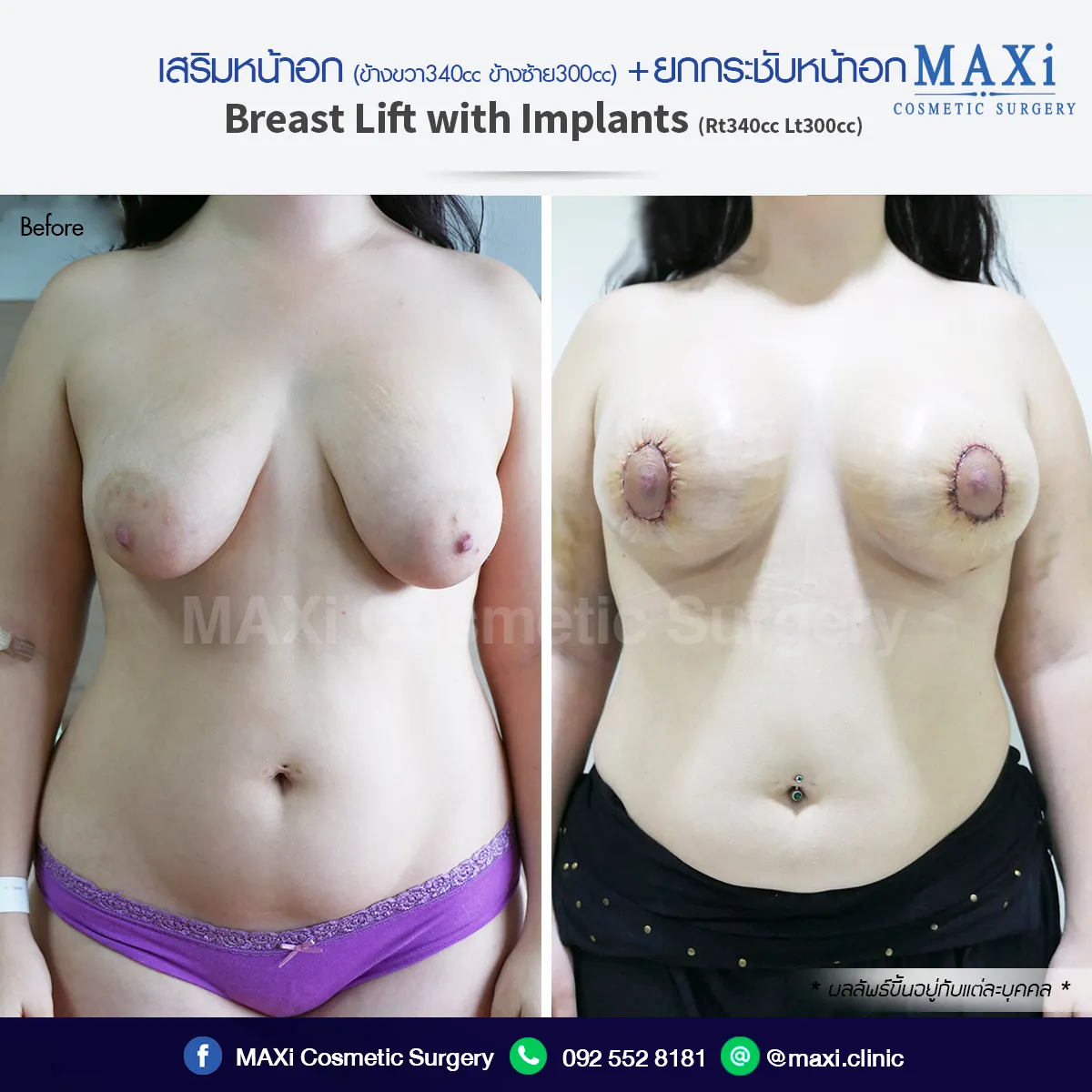 Before–After เสริมหน้าอกและยกกระชับหน้าอก เห็นผลชัดเจน ทรงสวยเป็นธรรมชาติ