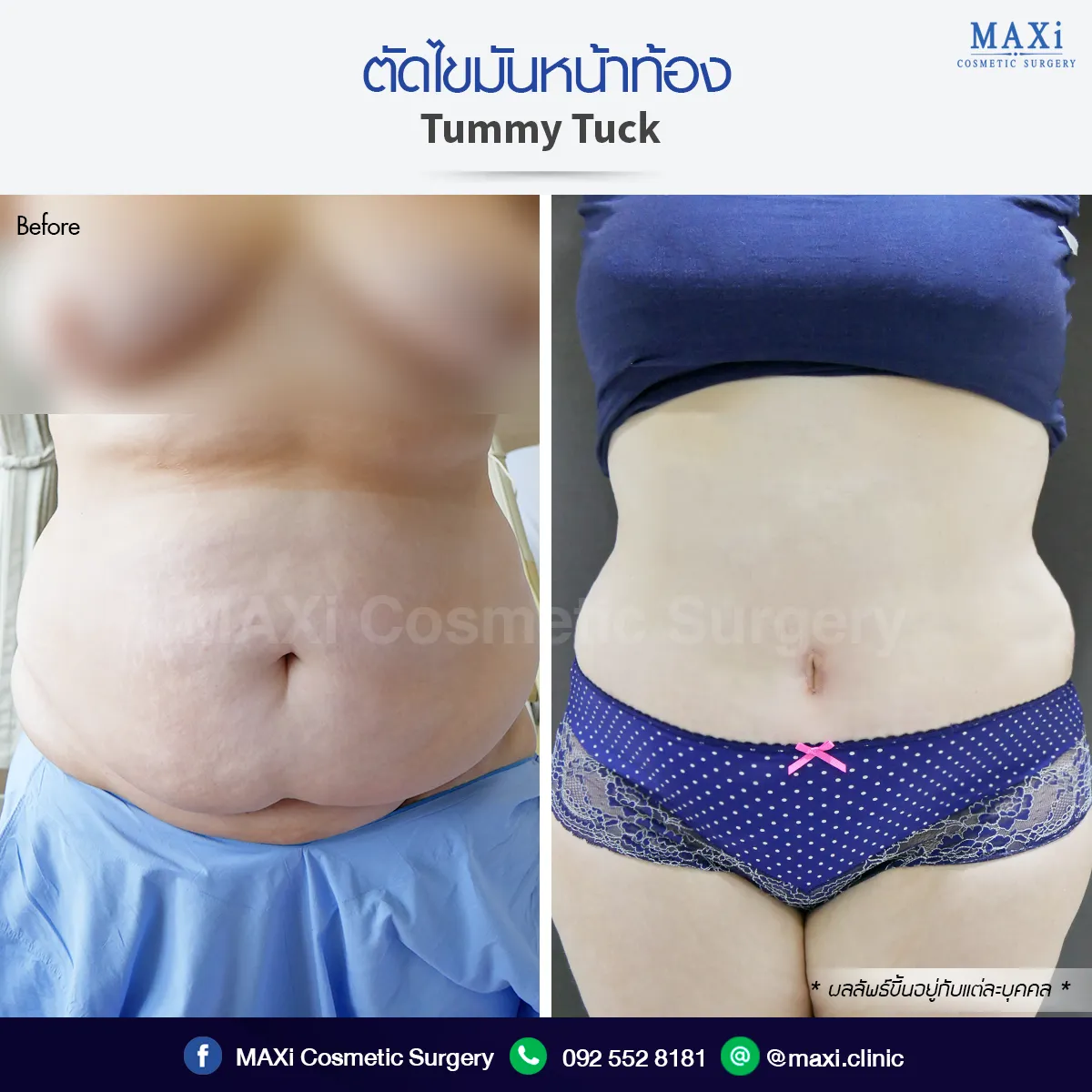 รีวิวตัดไขมันหน้าท้อง ช่วยให้รูปร่างกระชับ สัดส่วนดูดีขึ้น