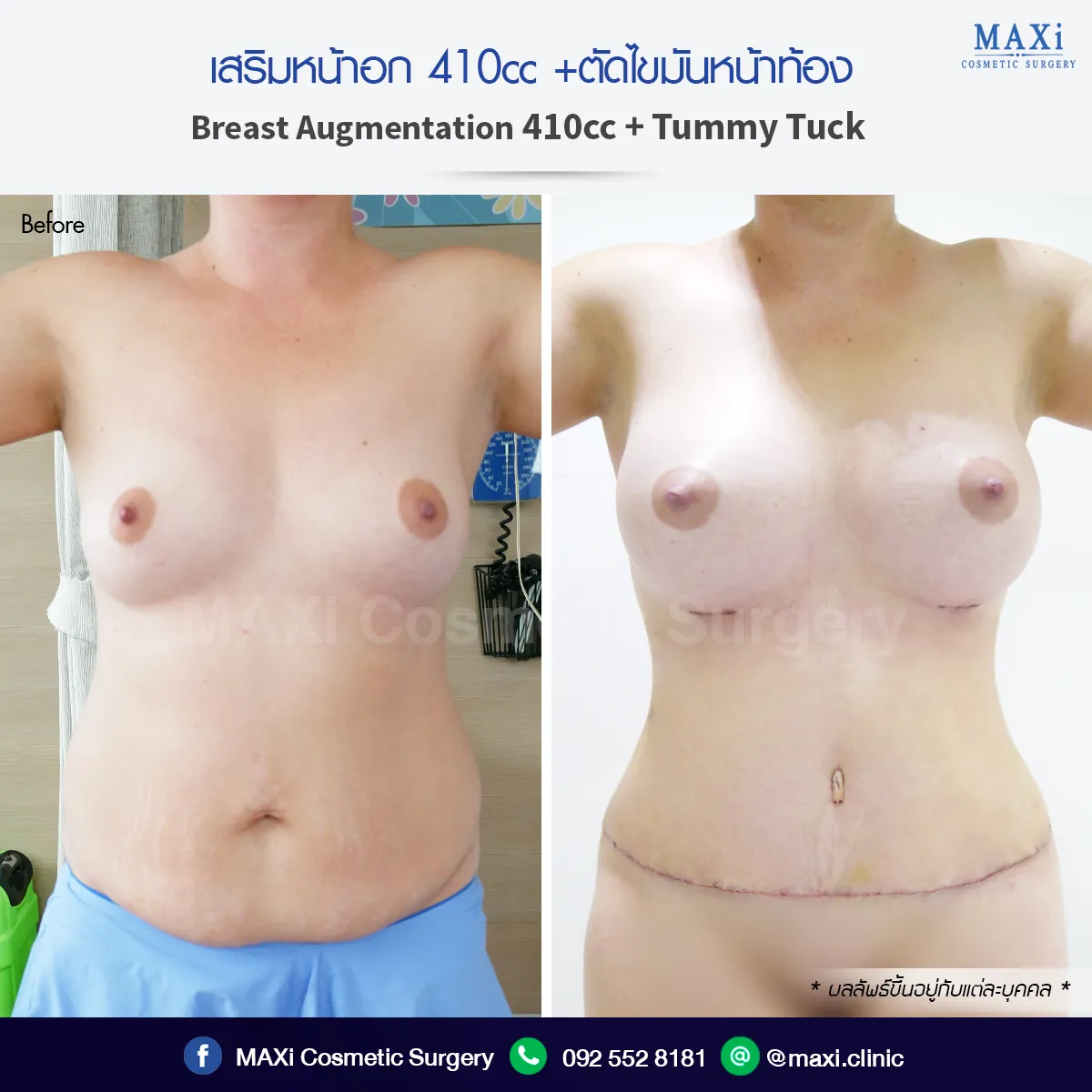 ผลลัพธ์เสริมหน้าอกพร้อมตัดไขมันหน้าท้อง หุ่นได้สัดส่วน เอวเล็ก อกชัด