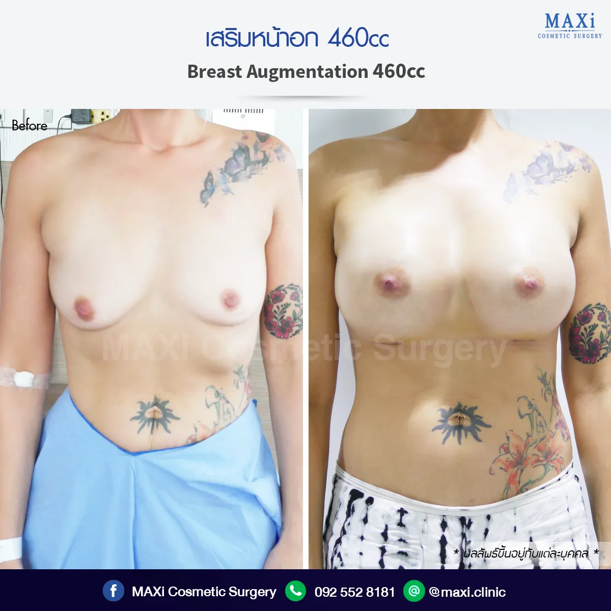 ผลลัพธ์เสริมหน้าอกด้วยซิลิโคนมาตรฐาน เห็นทรงชัดและเข้ากับรูปร่าง