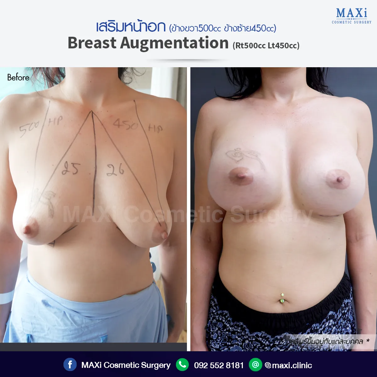 เสริมหน้าอกทรงสวยโดยศัลยแพทย์ผู้เชี่ยวชาญ ที่คลินิกศัลยกรรม