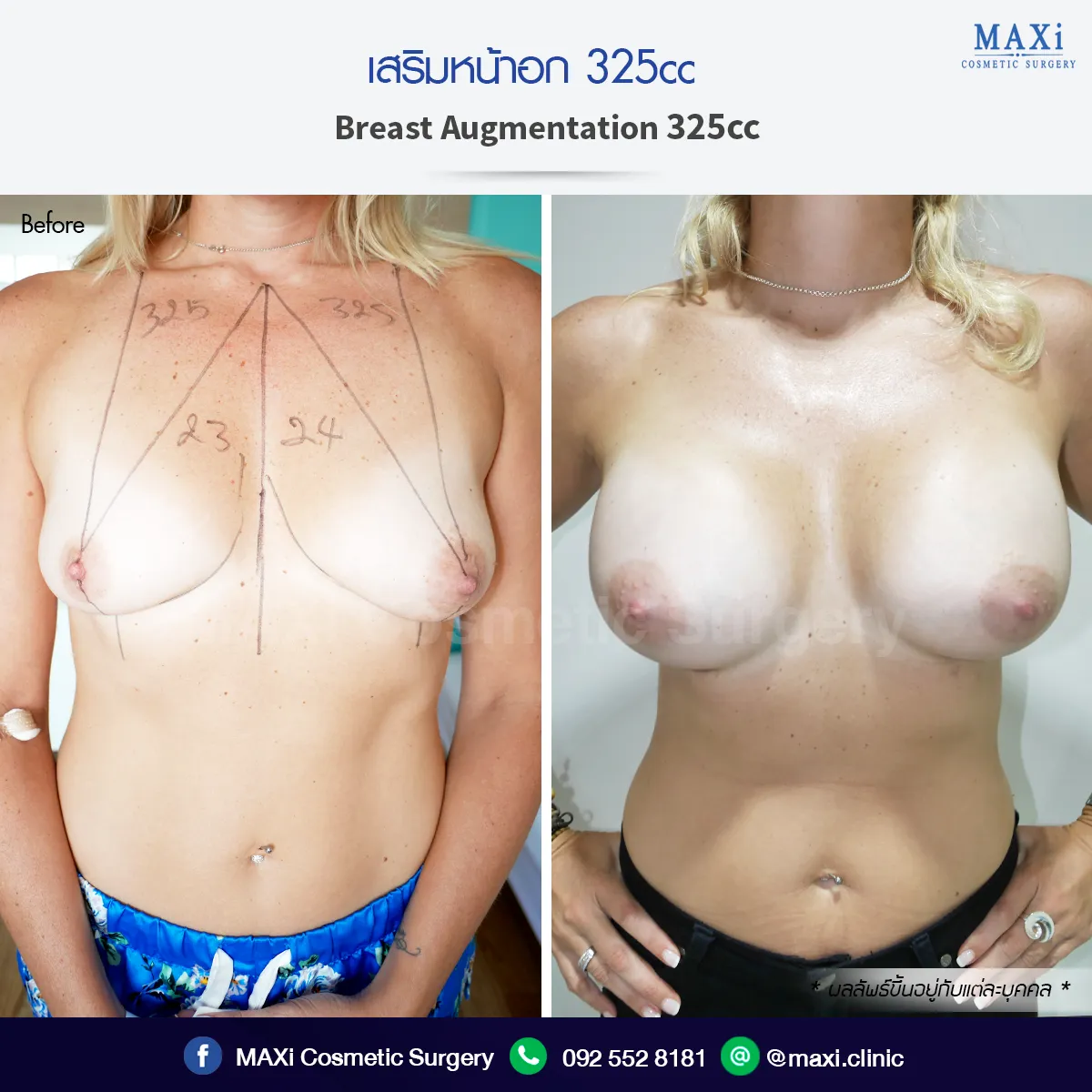 ภาพก่อน–หลังเสริมหน้าอก ทรงชัด อกอิ่มสวยเป็นธรรมชาติ