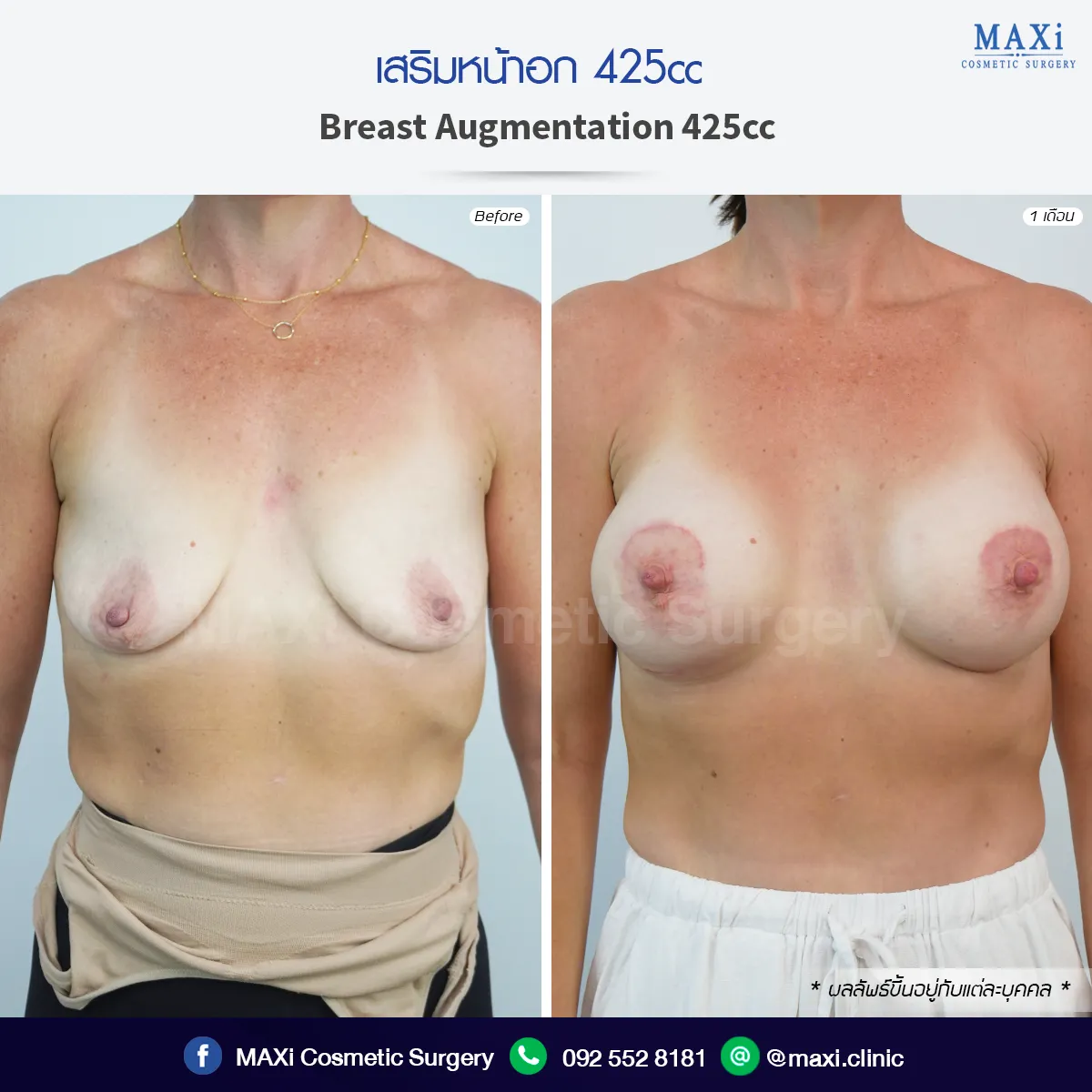 รีวิวเสริมหน้าอก 425cc พร้อมยกกระชับหน้าอก แก้ปัญหาหน้าอกหย่อนคล้อย เพิ่มความอิ่มเต็มและได้รูปทรงสวยเป็นธรรมชาติ