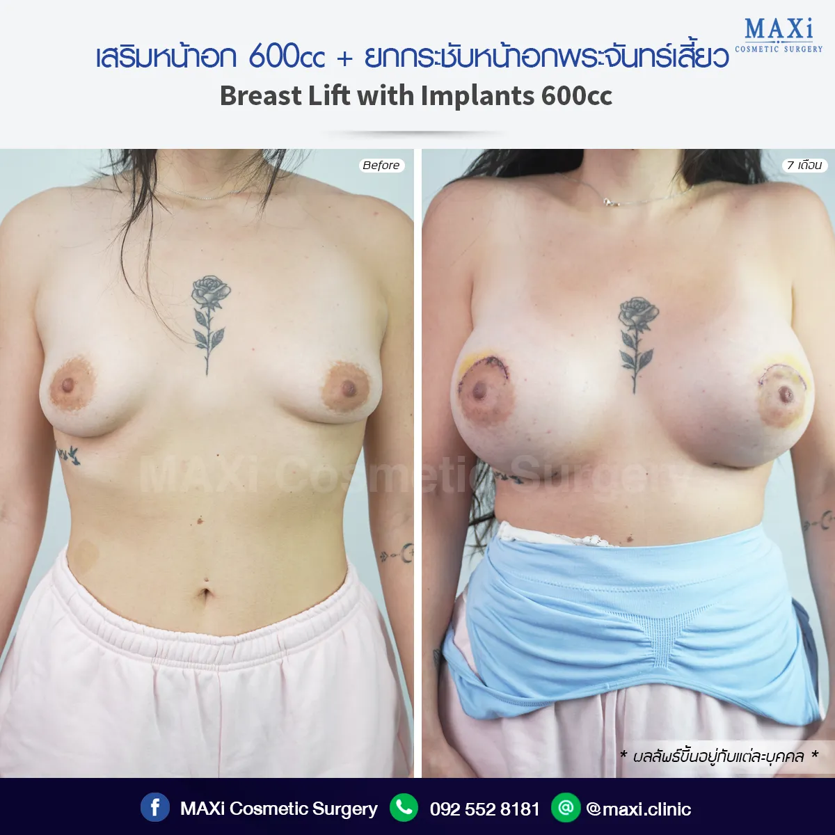 รีวิวเสริมหน้าอก 360cc พร้อมเทคนิคยกกระชับหน้าอก ช่วยให้ทรงสวย ชัดเจน และดูเป็นธรรมชาติ