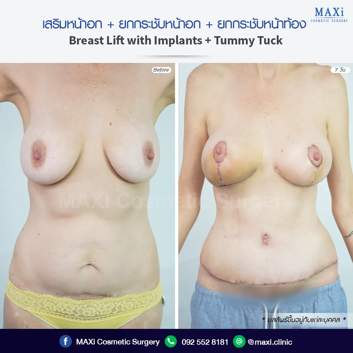 ผ่าตัดยกกระชับหน้าอกและเสริมหน้าอก เพื่อแก้ปัญหาหน้าอกตกคล้อย เพิ่มความมั่นใจและความกระชับ