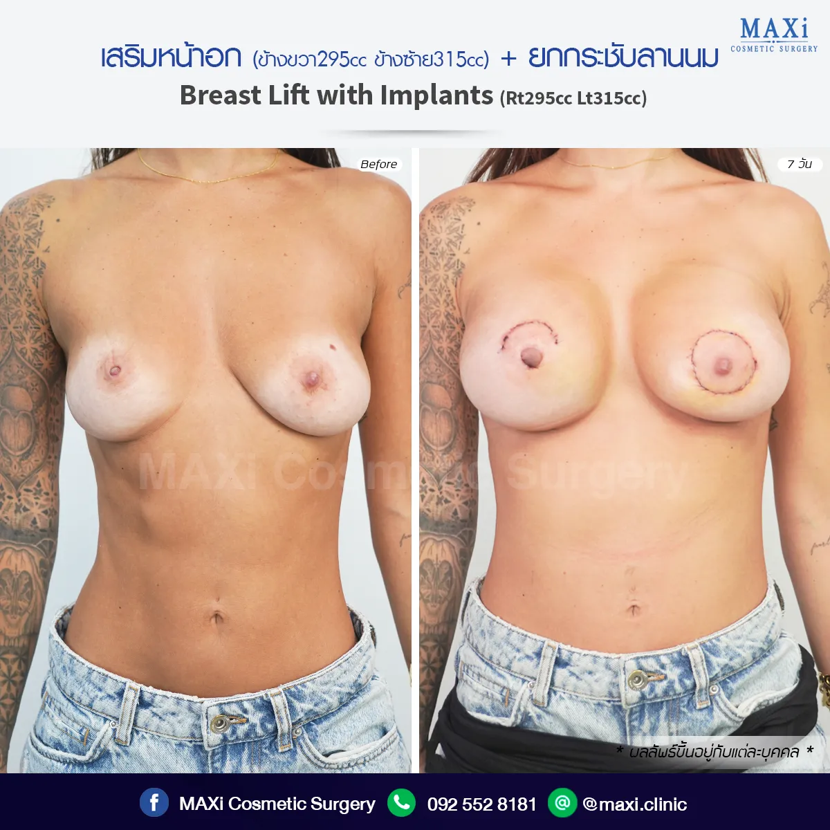 เสริมหน้าอกพร้อมยกกระชับหน้าอก แก้หน้าอกหย่อนคล้อยหลังคลอดหรือหลังลดน้ำหนัก ให้หน้าอกกระชับและดูอ่อนเยาว์