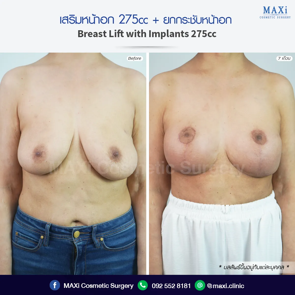 ผลลัพธ์เสริมหน้าอก 275cc ร่วมกับยกกระชับหน้าอก ช่วยปรับทรงหน้าอกให้เต่งตึง ดูสมส่วนมากขึ้น