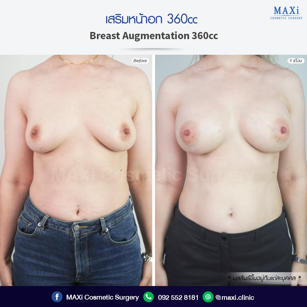 ภาพก่อนและหลังเสริมหน้าอก ทรงอกอิ่มสวยเป็นธรรมชาติ โดยเสริมหน้าอกหมอคณิต สำหรับผู้ที่กำลังค้นหาว่าเสริมหน้าอกที่ไหนดี