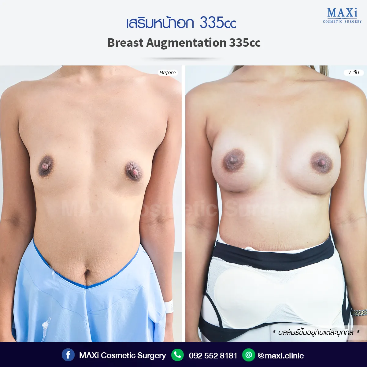 รีวิวผลลัพธ์ก่อนและหลังเสริมหน้าอก ทรงสวยได้รูปโดยเสริมหน้าอกหมอคณิต สำหรับคนที่สนใจเสริมหน้าอกและกำลังหาข้อมูลเสริมหน้าอกที่ไหนดี