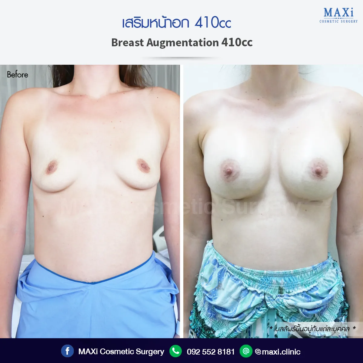 ภาพเปรียบเทียบก่อนและหลังเสริมหน้าอก ทรวงอกดูอวบอิ่มสมส่วน เสริมหน้าอกหมอคณิต เหมาะสำหรับผู้ที่สงสัยว่าเสริมหน้าอกที่ไหนดี