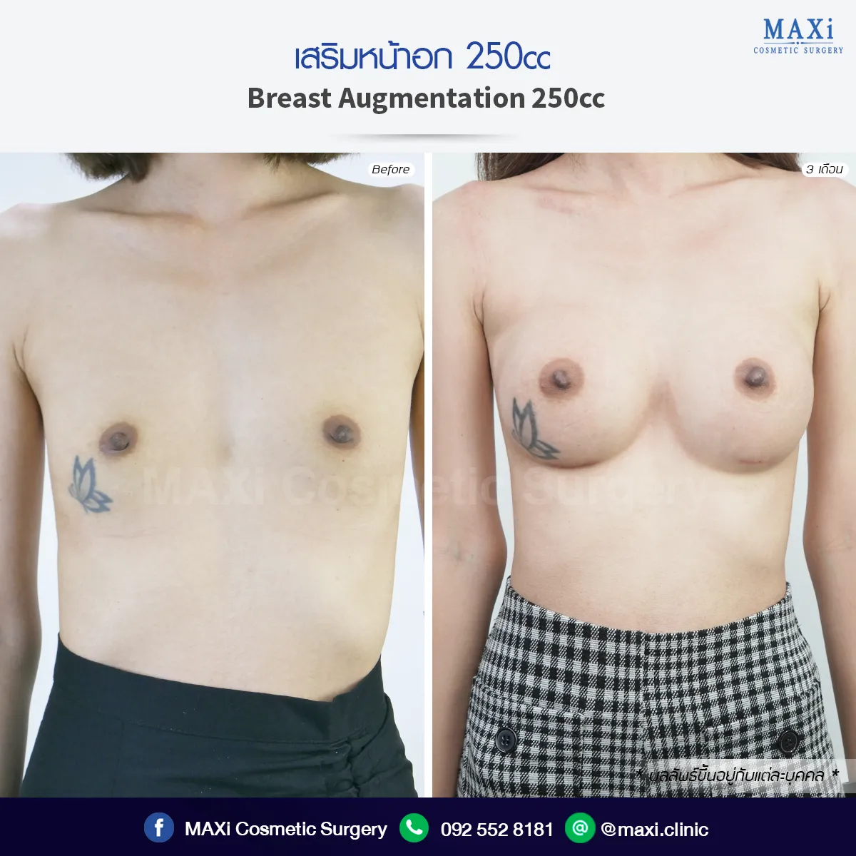 รีวิวเสริมหน้าอกก่อนหลัง เห็นผลลัพธ์ทรงอกสวยได้รูปโดยเสริมหน้าอกหมอคณิต คำตอบสำหรับคนที่กำลังค้นหาว่าเสริมหน้าอกที่ไหนดี