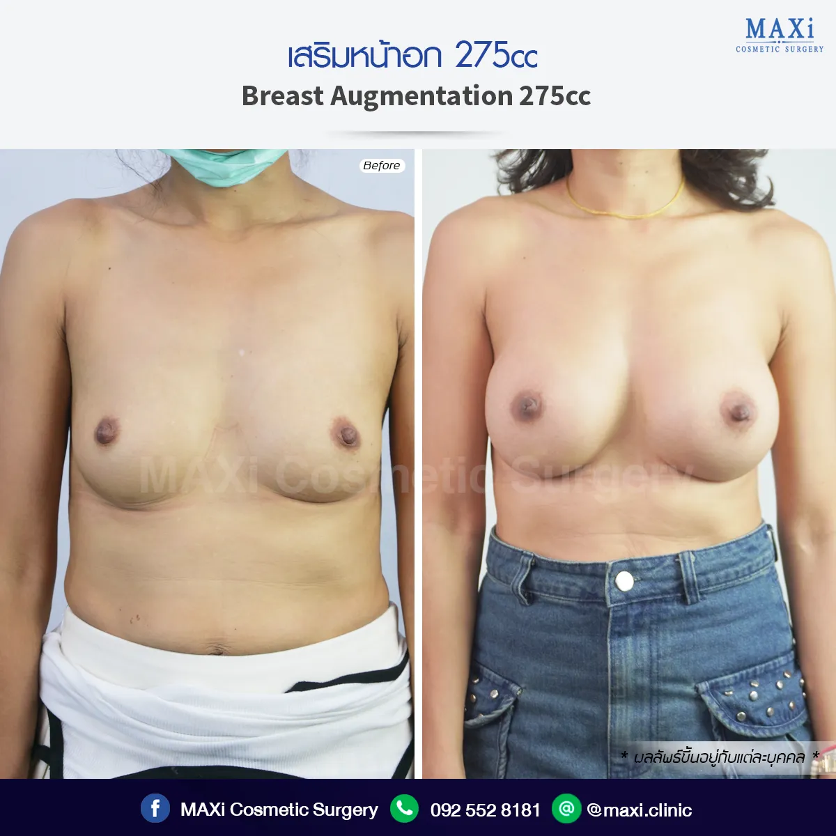 ภาพก่อนหลังเสริมหน้าอก ทรวงอกดูอิ่มเต็มและเข้ากับรูปร่าง ด้วยเทคนิคเสริมหน้าอกหมอคณิต สำหรับผู้ที่สนใจเสริมหน้าอกที่ไหนดี