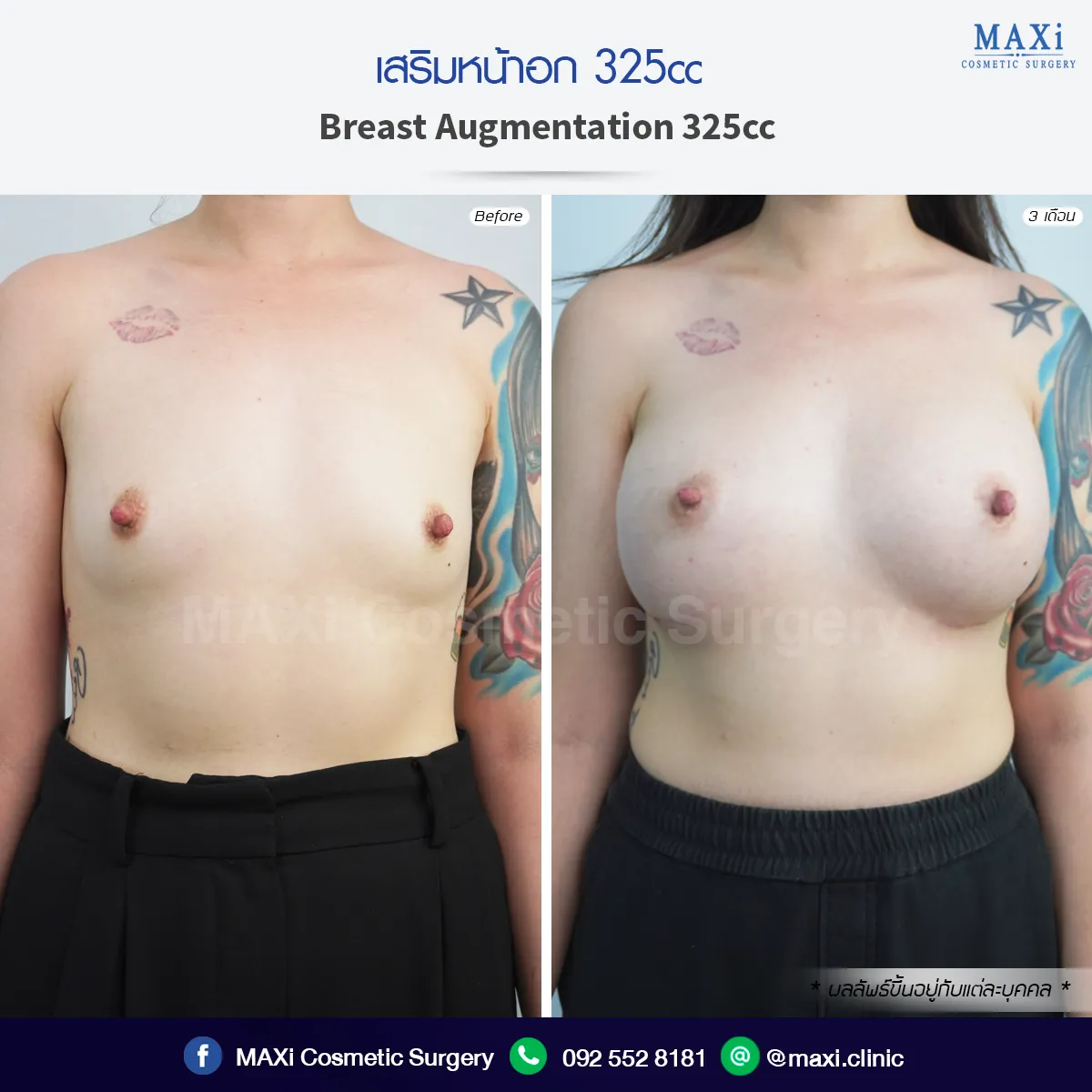 ภาพก่อนและหลังเสริมหน้าอก ทรงอกดูอิ่มเต็มและสมส่วน ผลลัพธ์จากการเสริมหน้าอกหมอคณิต สำหรับผู้ที่กำลังหาข้อมูลเสริมหน้าอกที่ไหนดี