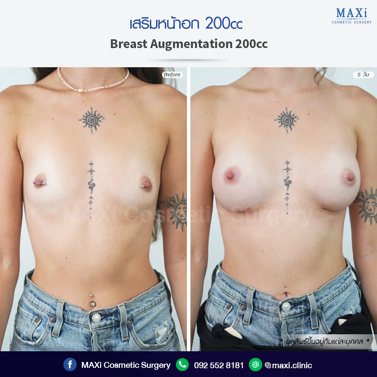รีวิวก่อนหลังเสริมหน้าอก เห็นความแตกต่างของทรวงอกอย่างชัดเจน เสริมหน้าอกหมอคณิต ทางเลือกของคนที่กำลังค้นหาเสริมหน้าอกที่ไหนดี
