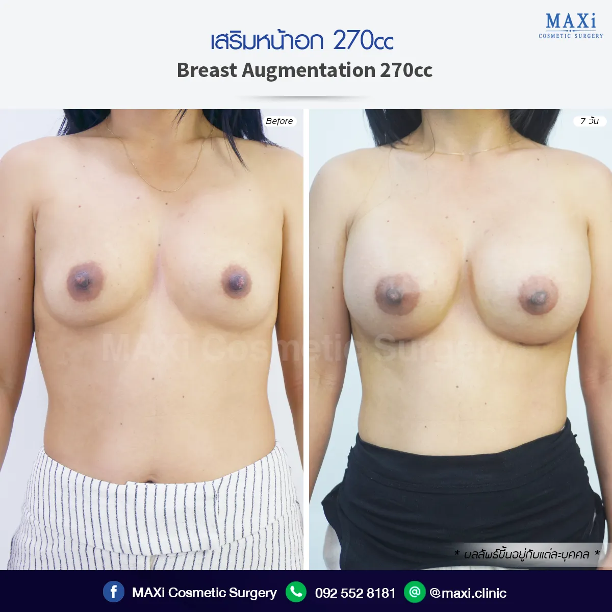 ผลลัพธ์เสริมหน้าอกก่อนและหลังผ่าตัด ทรวงอกดูมีมิติและเข้ากับรูปร่าง โดยเสริมหน้าอกหมอคณิต สำหรับคนที่สนใจเสริมหน้าอกที่ไหนดี