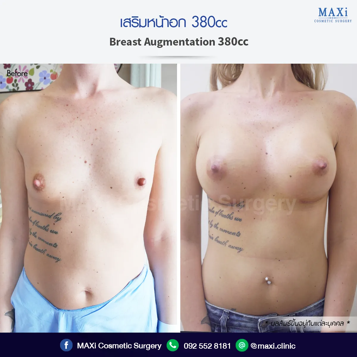 ภาพรีวิวก่อนหลังเสริมหน้าอก เพิ่มความมั่นใจให้รูปร่างโดยรวม ด้วยเทคนิคเสริมหน้าอกหมอคณิต สำหรับผู้ที่กำลังค้นหาเสริมหน้าอกที่ไหนดี