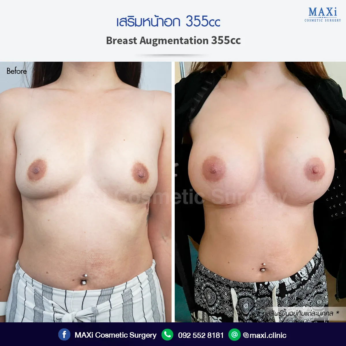 เปรียบเทียบผลลัพธ์ก่อนและหลังเสริมหน้าอก ทรงอกดูเป็นธรรมชาติและเข้ากับสรีระ เสริมหน้าอกหมอคณิต สำหรับคนที่กำลังตัดสินใจเสริมหน้าอกที่ไหนดี