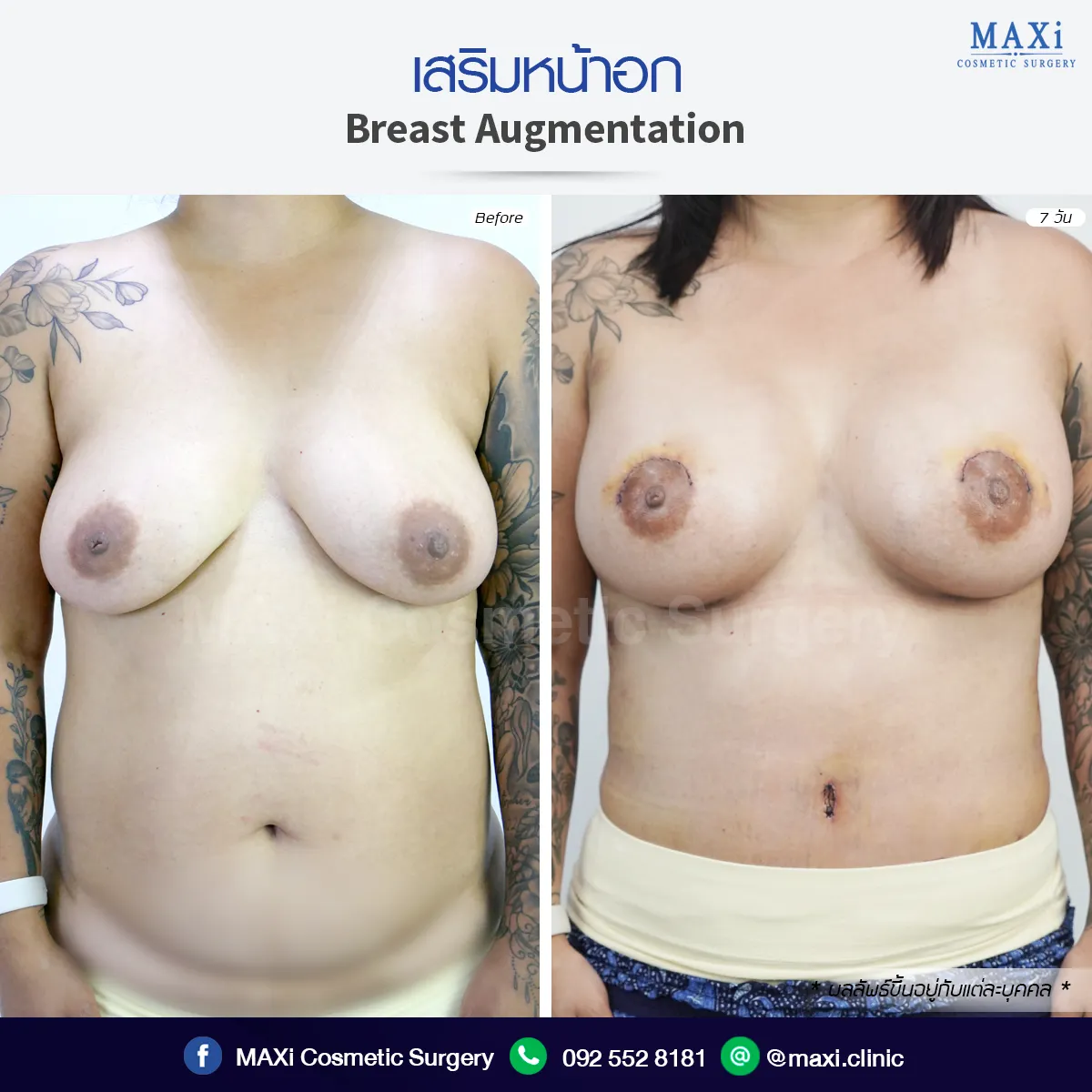 รีวิวก่อนหลังยกกระชับหน้าอก สำหรับผู้ที่มีปัญหานมหย่อนคล้อย หลังผ่าตัดหน้าอกดูเต่งตึงและกระชับขึ้น