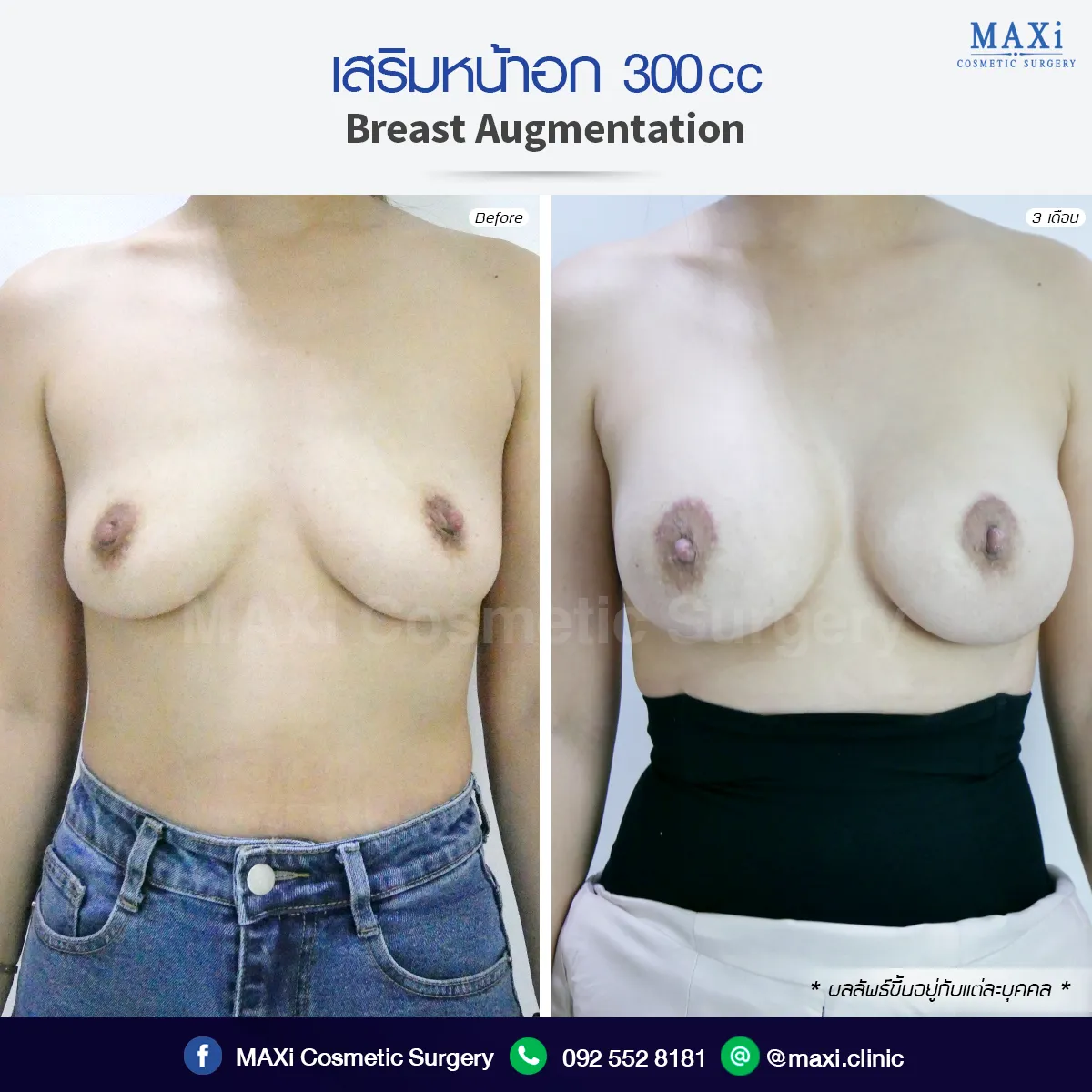 ภาพก่อนและหลังยกกระชับหน้าอก แก้ปัญหานมหย่อนคล้อย ให้ทรวงอกกลับมาเต่งตึงและได้รูปมากขึ้น