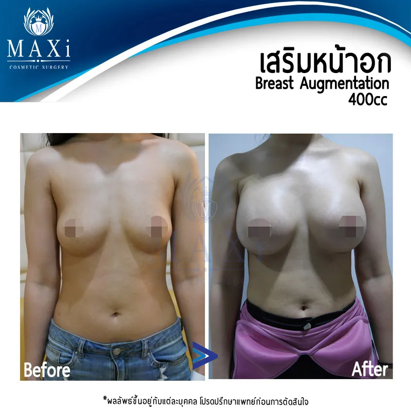 ภาพก่อนหลังเสริมหน้าอก ทรวงอกดูสวยสมส่วนและมีความอิ่มเต็ม ด้วยการผ่าตัดเสริมหน้าอกหมอคณิต เหมาะกับผู้ที่กำลังค้นหาเสริมหน้าอกที่ไหนดี