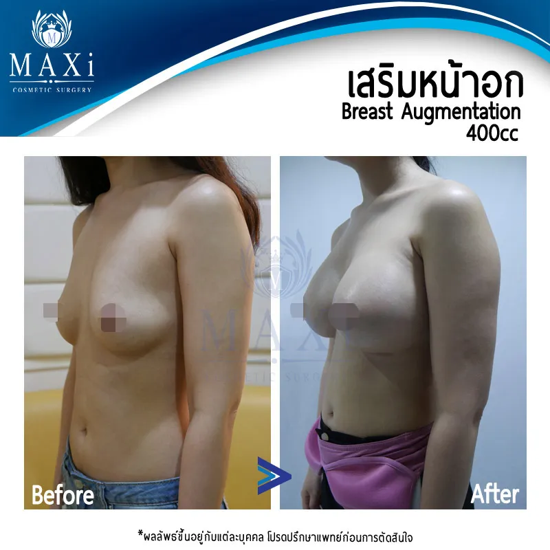 รีวิวเสริมหน้าอกก่อนและหลัง เห็นความเปลี่ยนแปลงของทรวงอกอย่างชัดเจน โดยเสริมหน้าอกหมอคณิต สำหรับผู้ที่กำลังหาข้อมูลเสริมหน้าอกที่ไหนดี