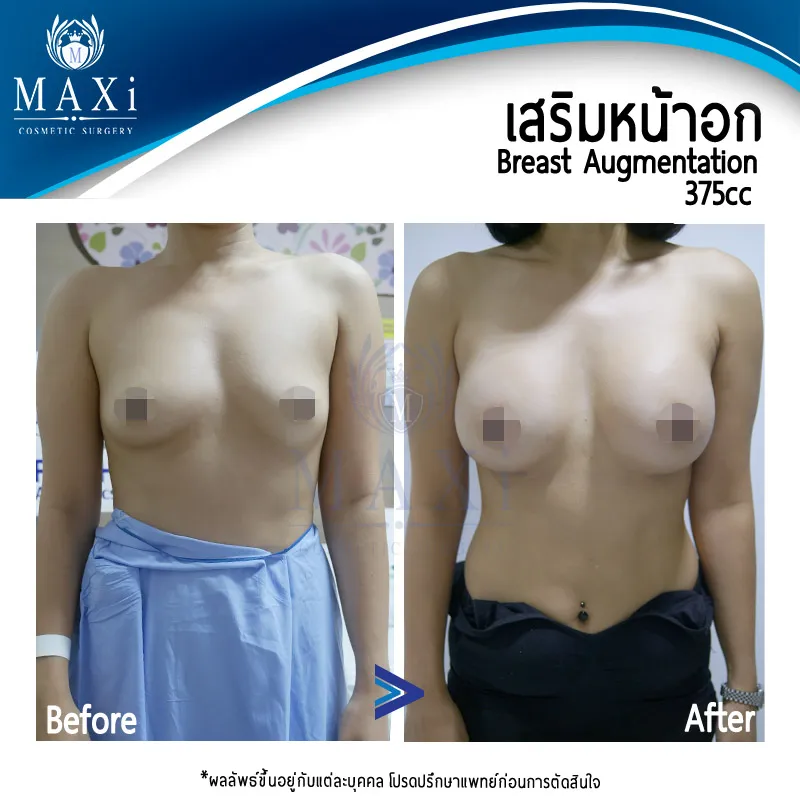 ภาพผลลัพธ์ก่อนหลังเสริมหน้าอก ทรงอกดูสวยละมุนและเป็นธรรมชาติ จากการเสริมหน้าอกหมอคณิต สำหรับผู้ที่สนใจเสริมหน้าอกที่ไหนดี