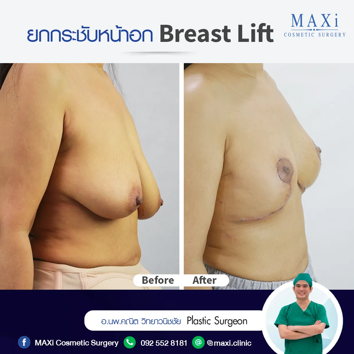 ภาพเปรียบเทียบก่อนหลังยกกระชับหน้าอก สำหรับผู้ที่มีปัญหานมหย่อนคล้อย หน้าอกกลับมาเต่งตึงและสมส่วน