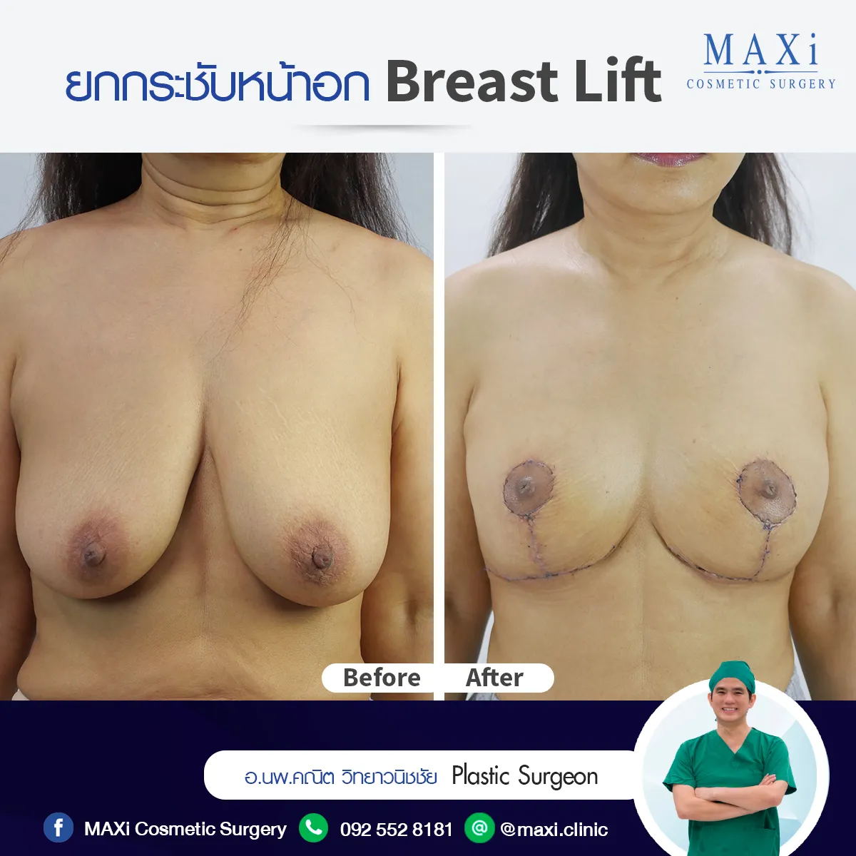 รีวิวผลลัพธ์ยกกระชับหน้าอก แก้ปัญหานมหย่อนคล้อย หลังทำหน้าอกดูเต่งตึงและมีรูปทรงที่สวยขึ้น