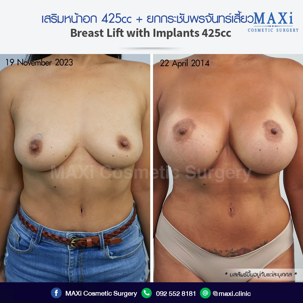 เปรียบเทียบผลลัพธ์ก่อนและหลังยกกระชับหน้าอก ช่วยแก้ไขนมหย่อนคล้อยให้หน้าอกเต่งตึงและได้สัดส่วน