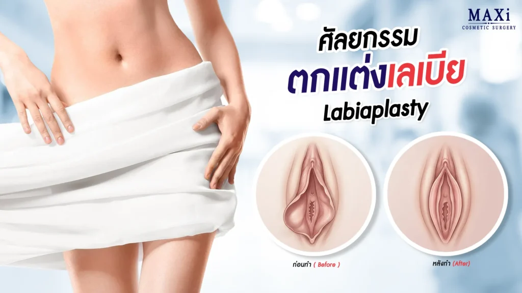 ลักษณะเลเบียหลังผ่าตัดแปลงเพศชายเป็นหญิง แสดงรูปทรงที่เป็นธรรมชาติ ตกแต่งเลเบียในประเทศไทยหมอคณิต