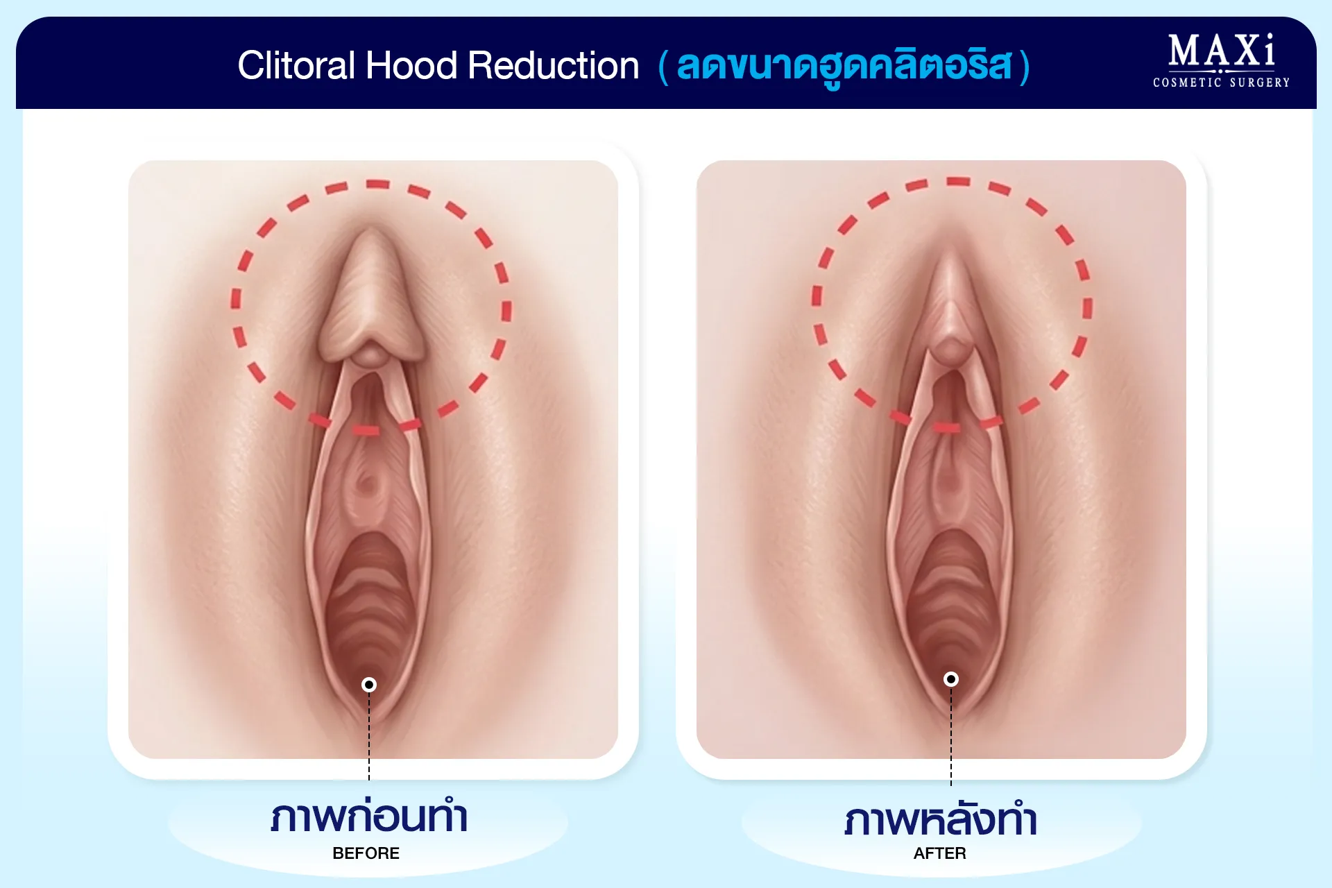 การปรับแต่งหนังหุ้มคลิตอริสหลังผ่าตัดแปลงเพศ เพื่อให้สัดส่วนดูสมดุลและสวยงามกับหมอคณิต