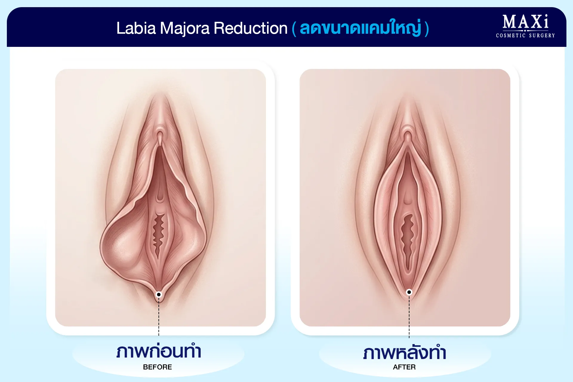 การลดขนาดแคมใหญ่หลังผ่าตัดแปลงเพศชายเป็นหญิง ช่วยให้รูปทรงสมดุลและเรียบเนียน ศัลยกรรมแปลงเพศหมอคณิต